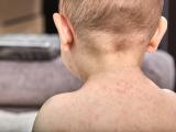 baby measles back