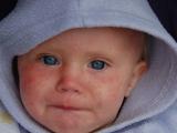 baby with measles